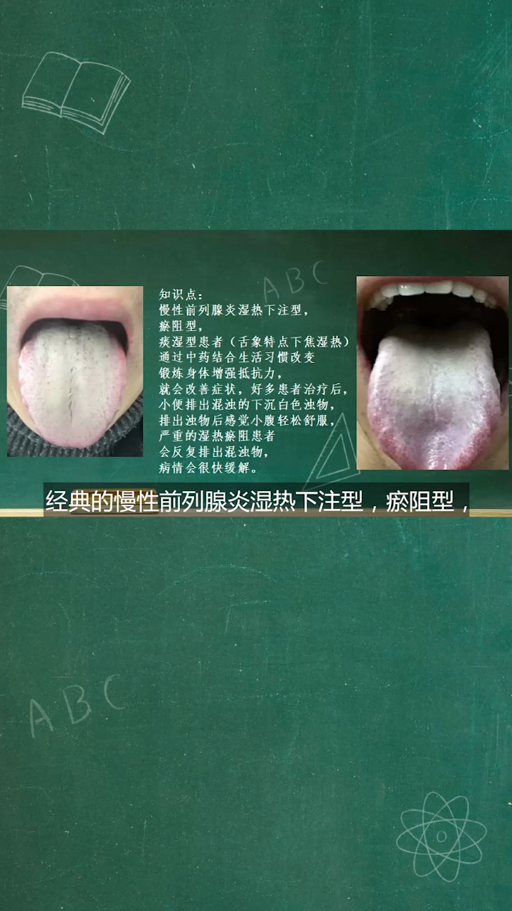 舌象分析:舌根部舌苔黄腻,湿热下注,脾虚的舌象讲解