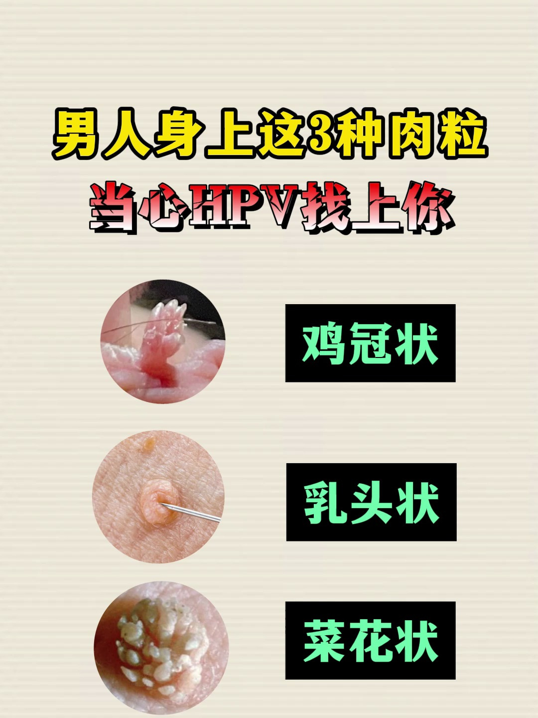 男人身上这3种肉粒当心HPV找上你