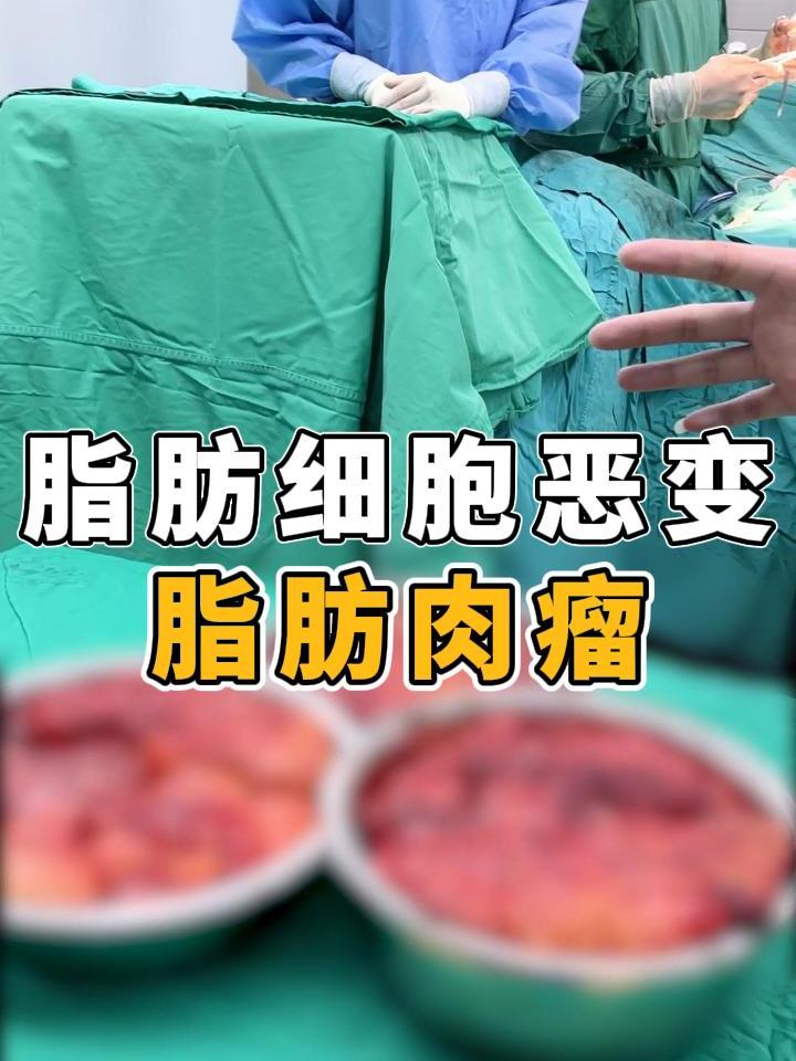 脂肪细胞恶变的罕见病-脂肪肉瘤