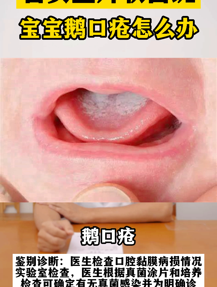 宝宝舌头上长了白色斑片,鹅口疮 这样处理就好了