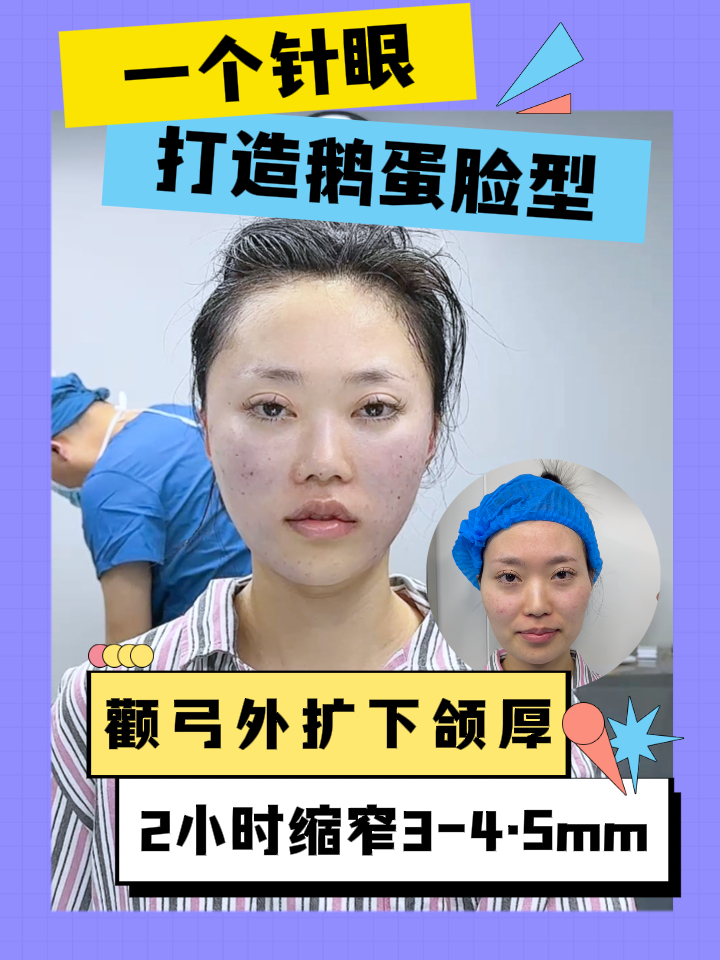 颧骨高+下颌肥厚,微创也能拥有鹅蛋脸,看看姑娘改善了哪些吧?