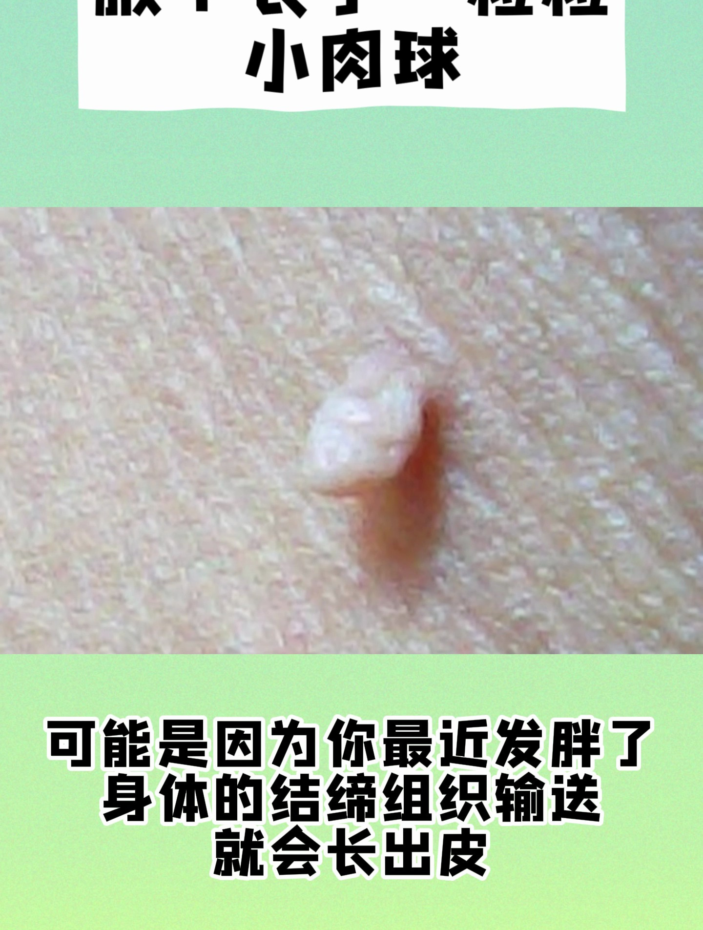 腋下长了一粒粒小肉球