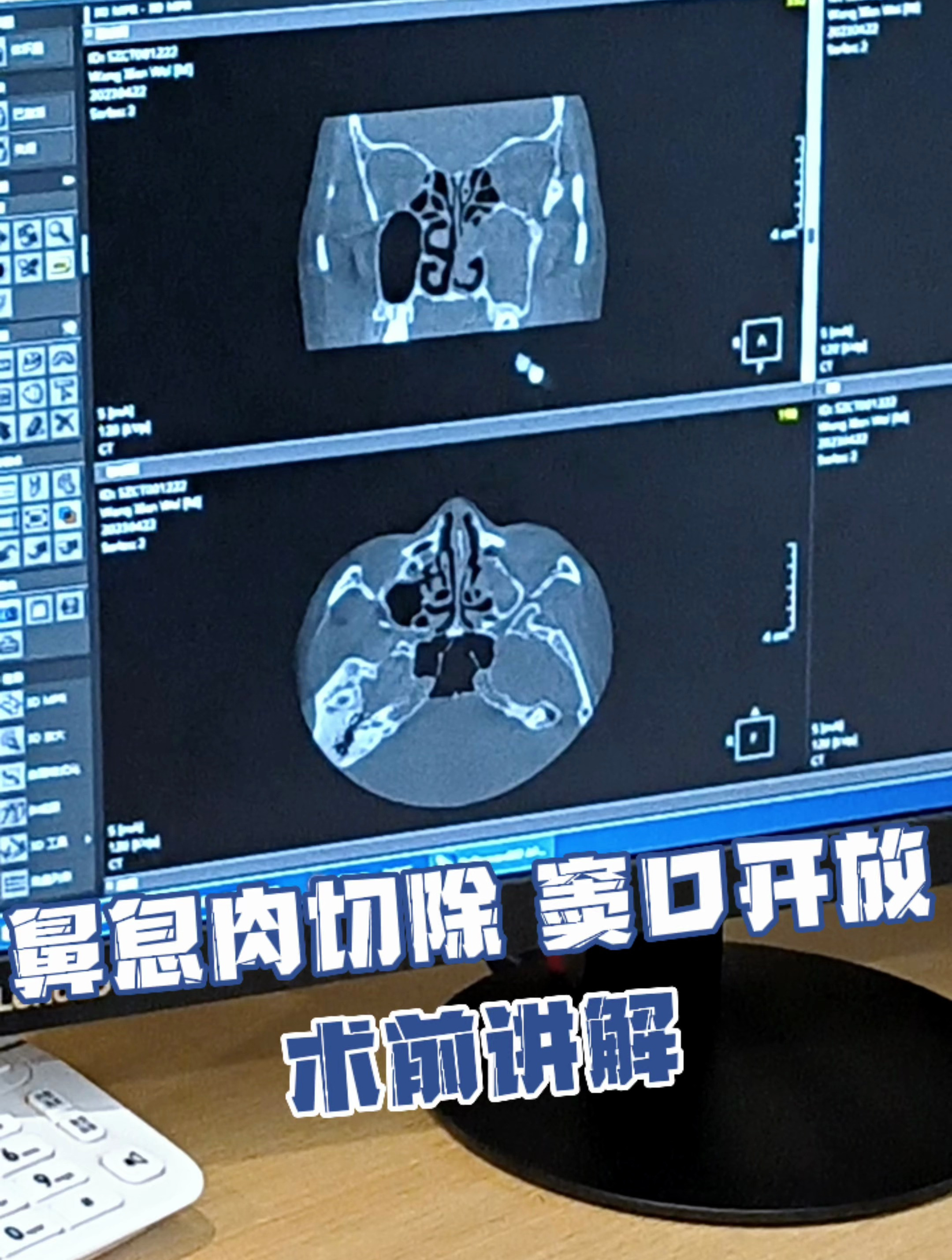 鼻息肉切除 窦口开放 术前讲解