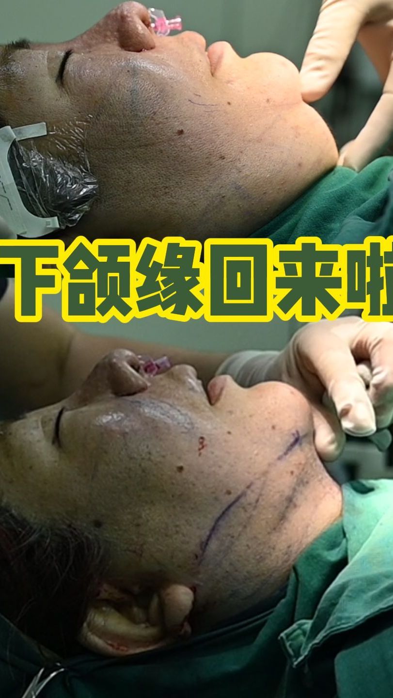 整个下巴一坨肉 看看算不算爆改
