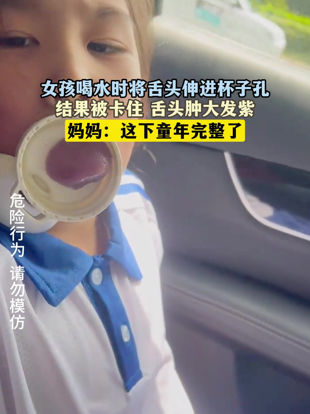 女孩喝水时将舌头伸进杯子孔,结果被卡住 舌头肿大发紫