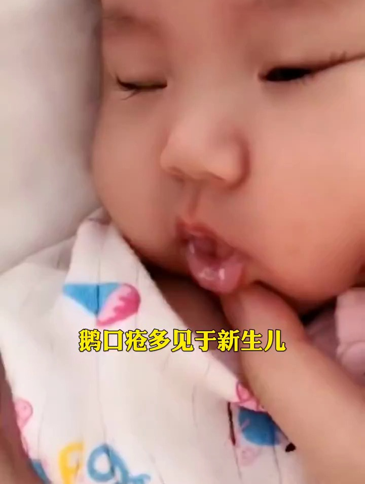 如何给宝宝清洁口腔,预防鹅口疮