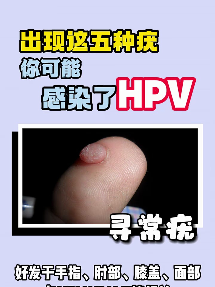 出现这五种疣,你可能感染了HPV