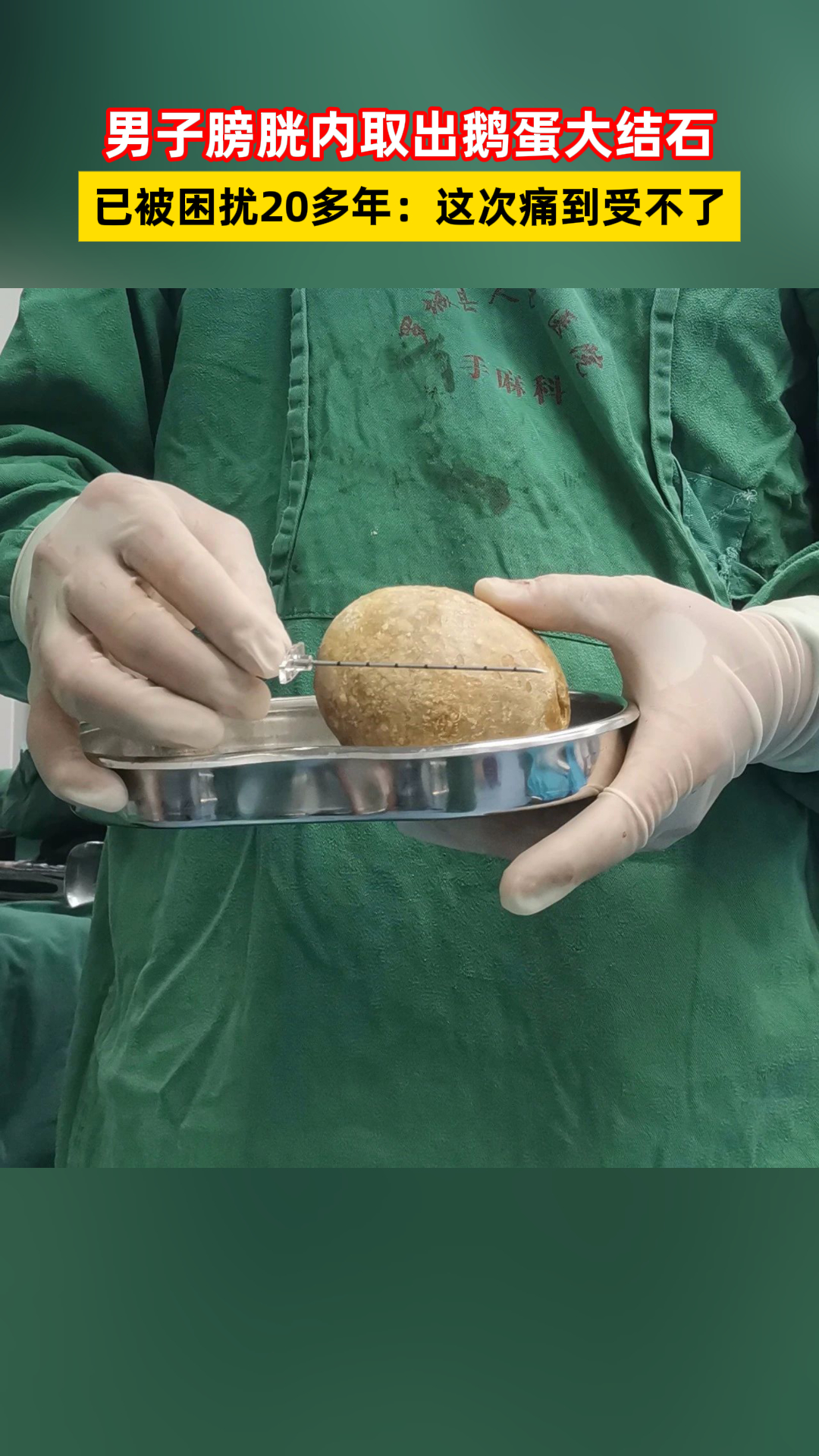 男子膀胱内取出鹅蛋大结石,已被困扰20多年:这次痛到受不了
