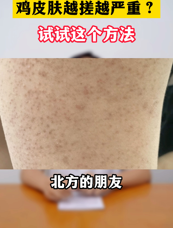 胳膊大腿的鸡皮疙瘩很难看，教你这个方法