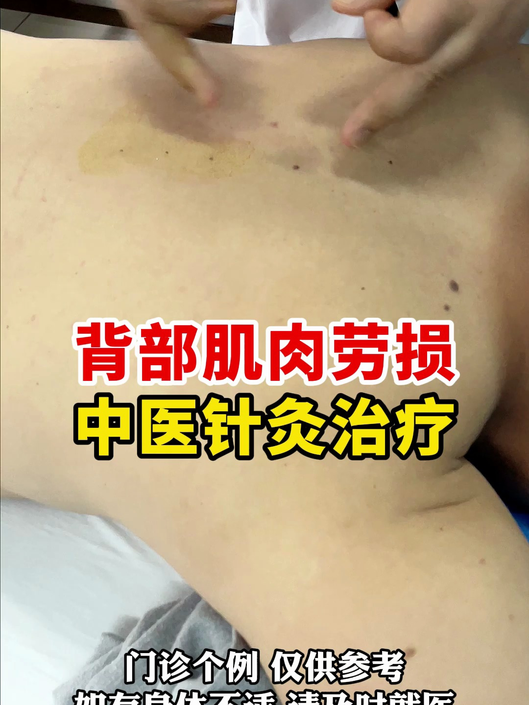 背部肌肉劳损中医针灸治疗