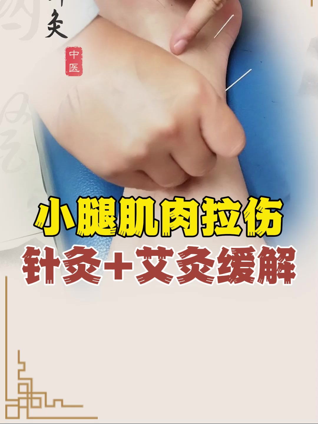 小腿肌肉拉伤针灸+艾灸缓解