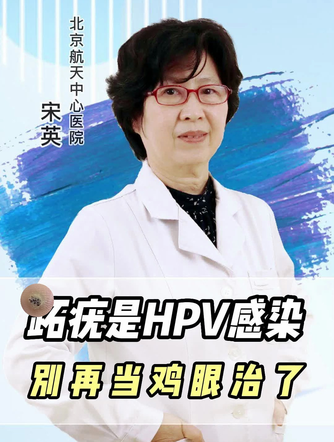 跖疣是HPV感染,别再当鸡眼治了