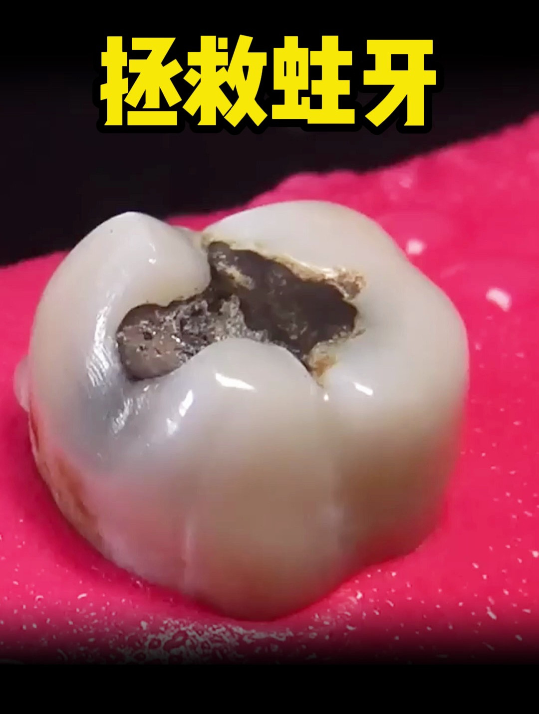 看看牙医如何拯救蛀牙!