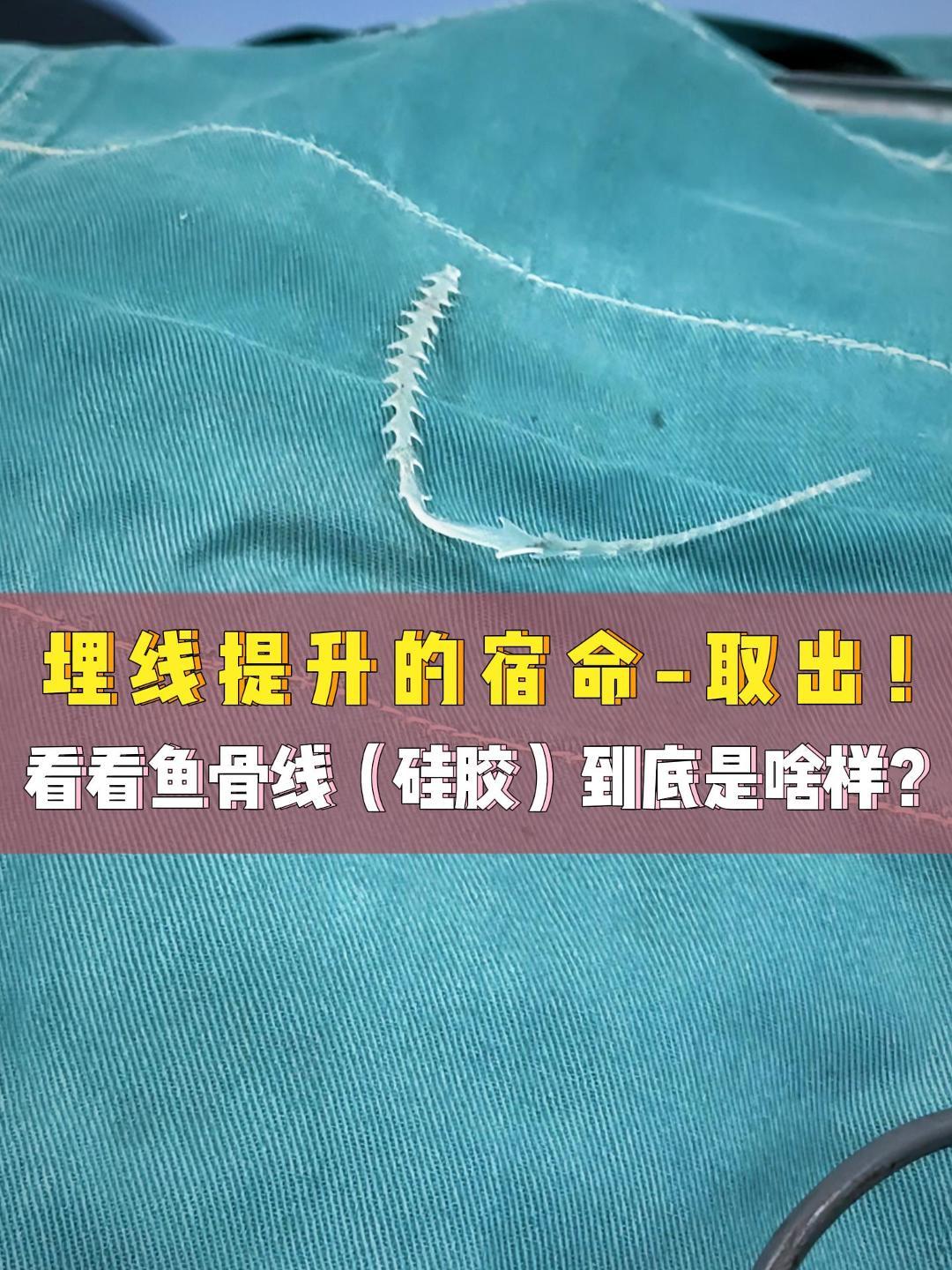 拉皮术中取出的鱼骨硅胶线(线雕线的一种),看看是啥样的!