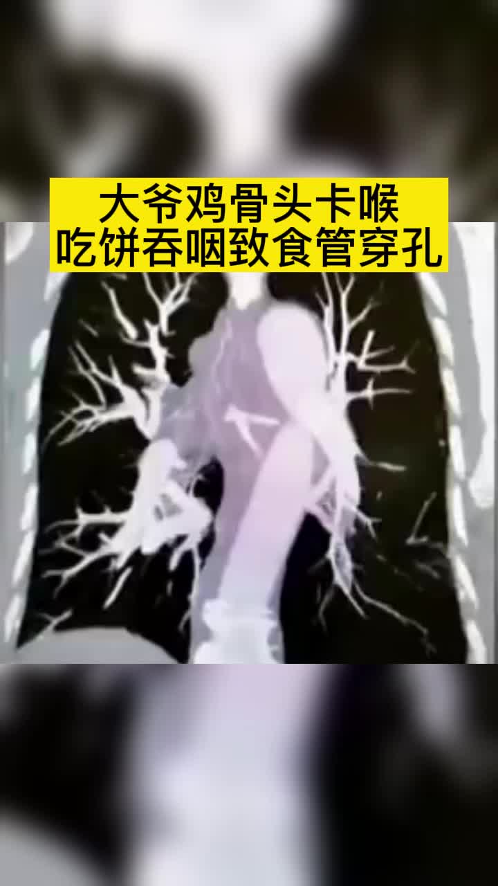 小心!徐州 一大爷鸡骨头卡喉咙,吃饼吞咽致食管穿孔 穿孔 健康