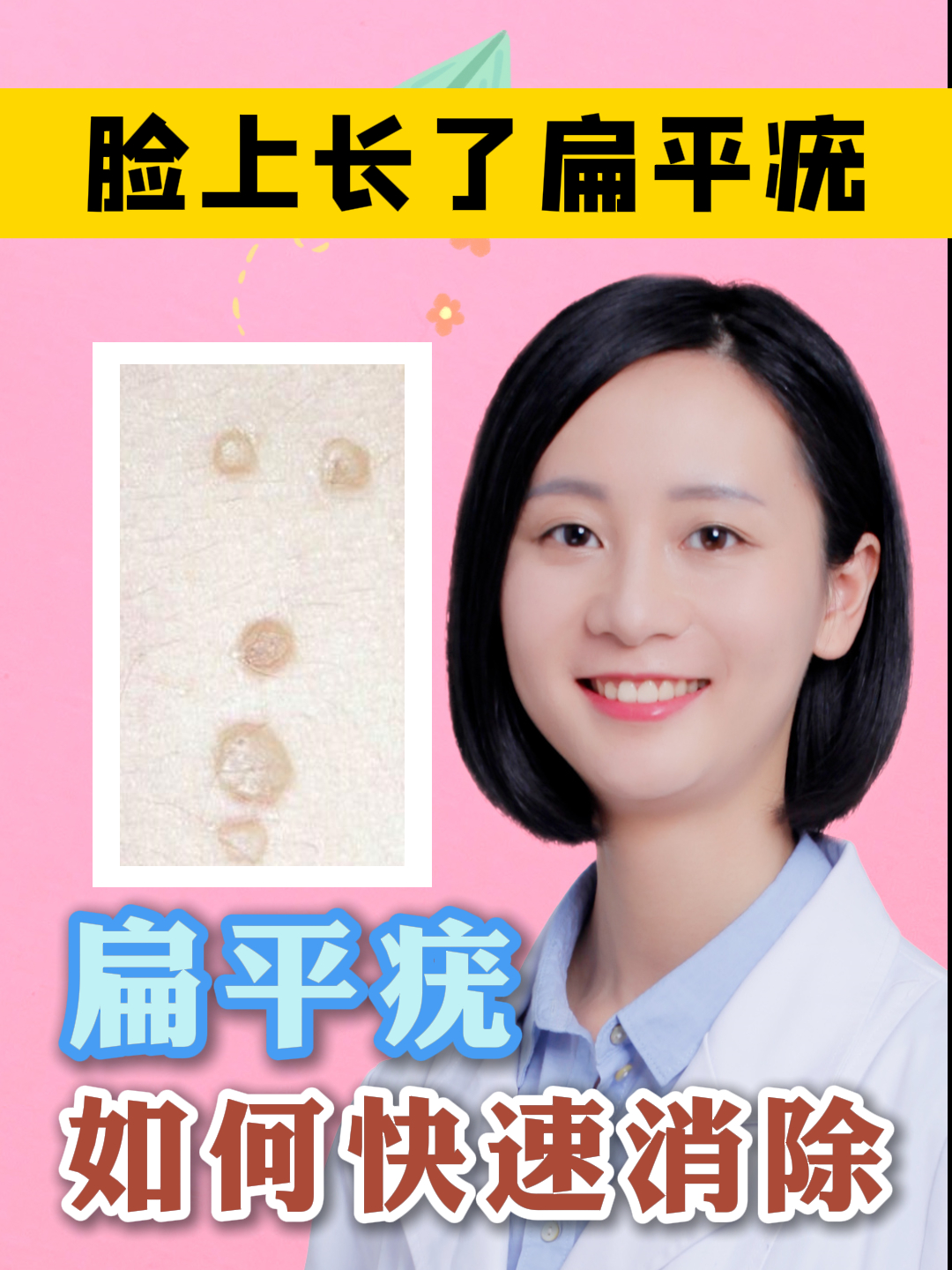 脸上长了扁平疣 如何快速消除