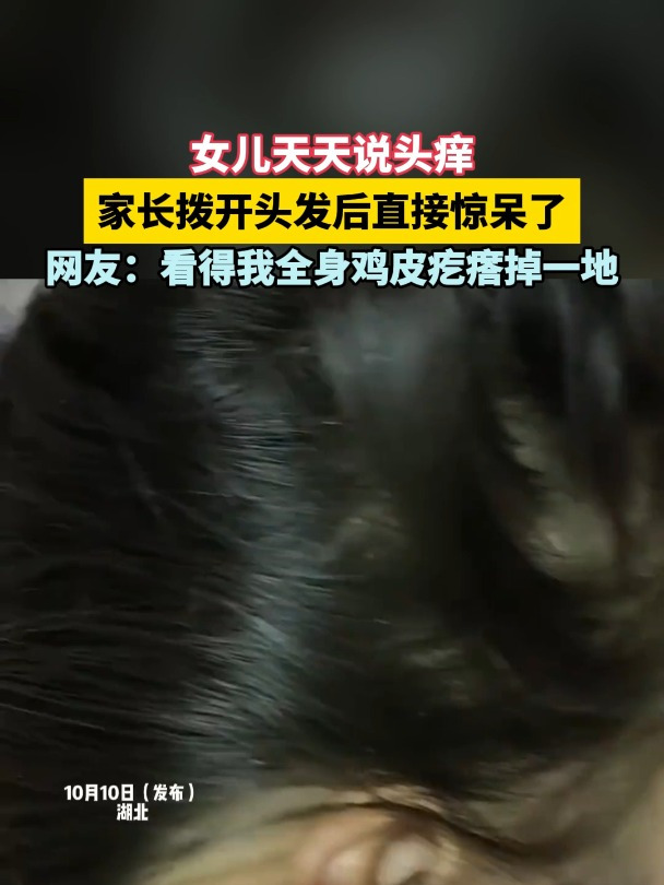 女儿天天说头痒 家长拨开头发后直接惊呆了 看得我全身鸡皮疙瘩掉一地