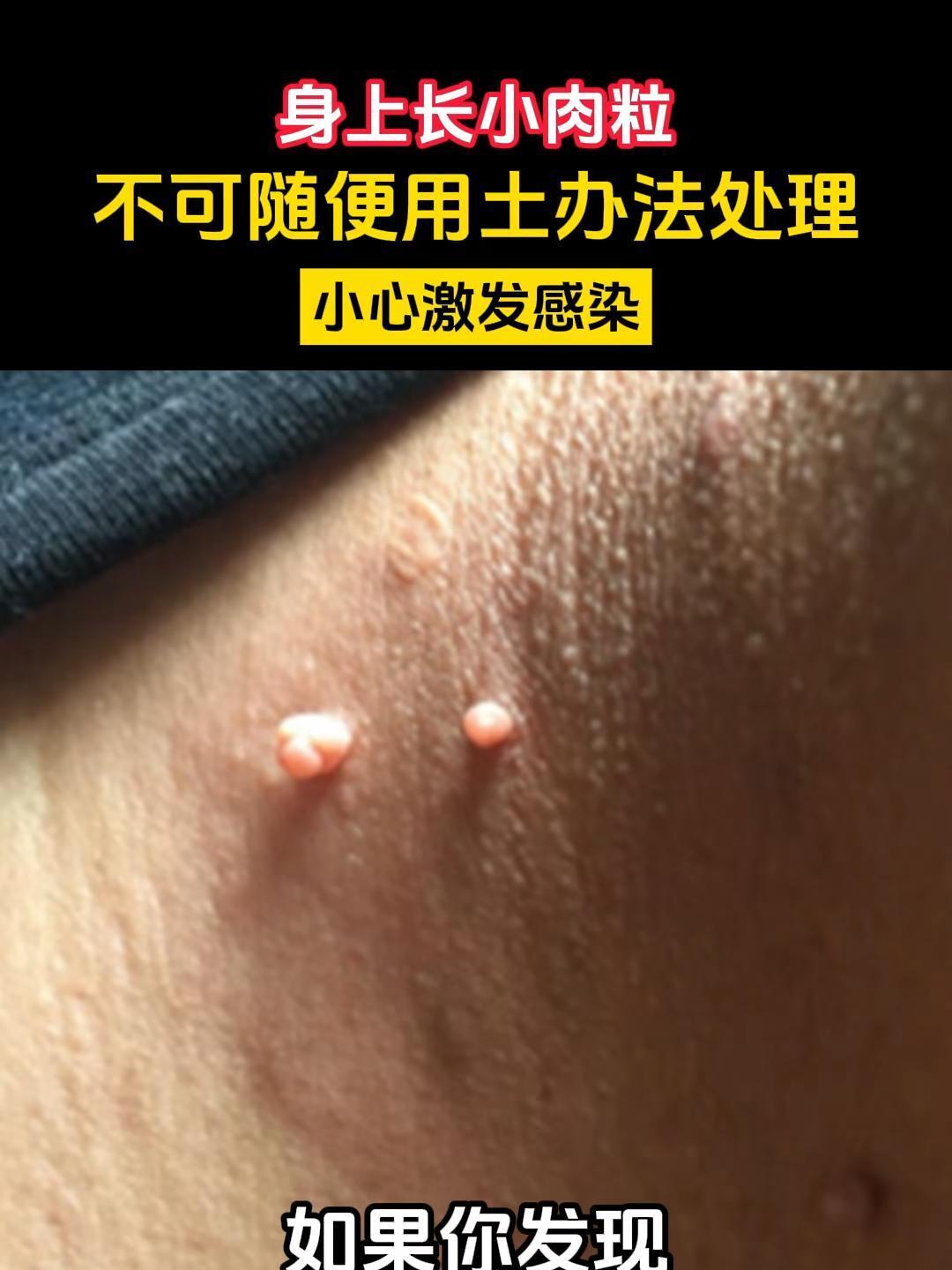 弓娟琴医生怎么样?专业指导身上长小肉粒不可随便用绳扯掉