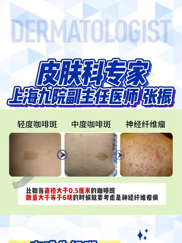 咖啡牛奶斑直径过大、数量过多就要当心了