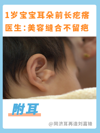 1岁宝宝耳朵长了个疙瘩,医生:切口特殊,美容缝合不留疤