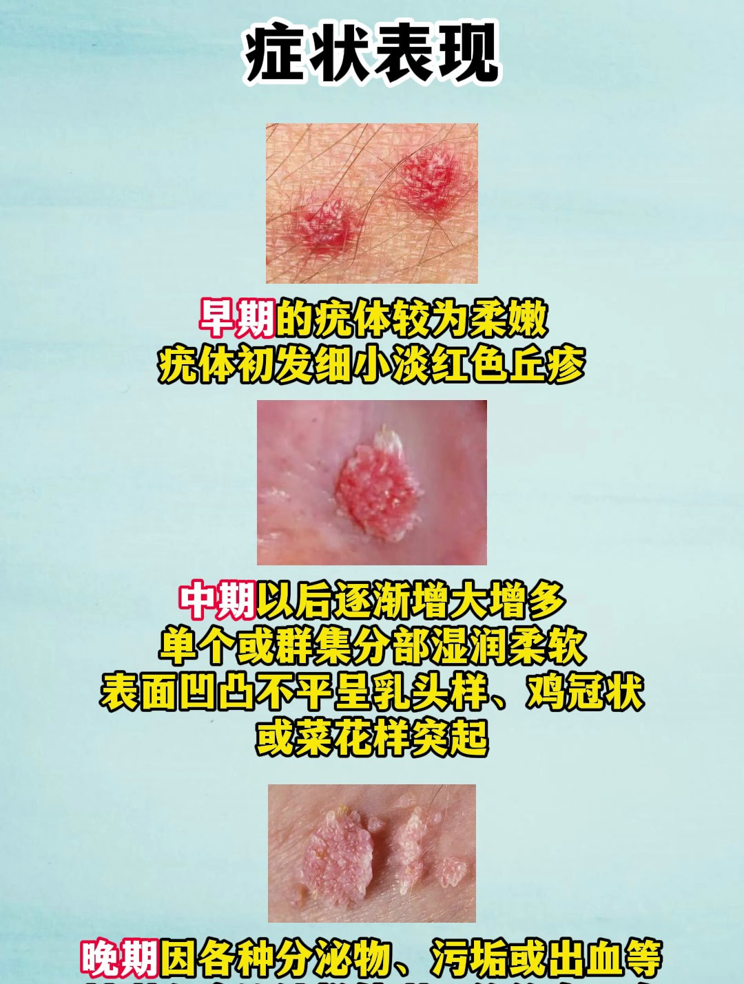 尖锐湿疣的症状表现,有了可别忽略