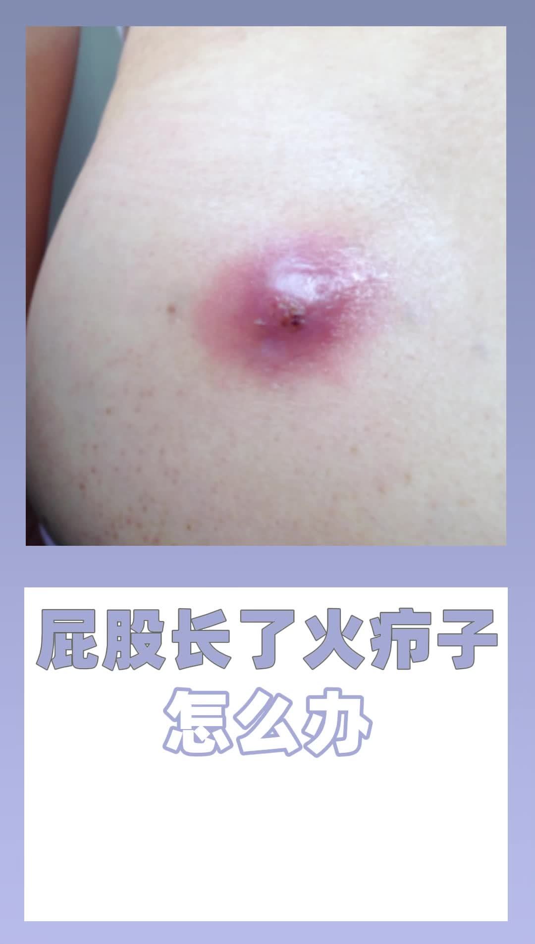 屁股长了火疖子 怎么办?