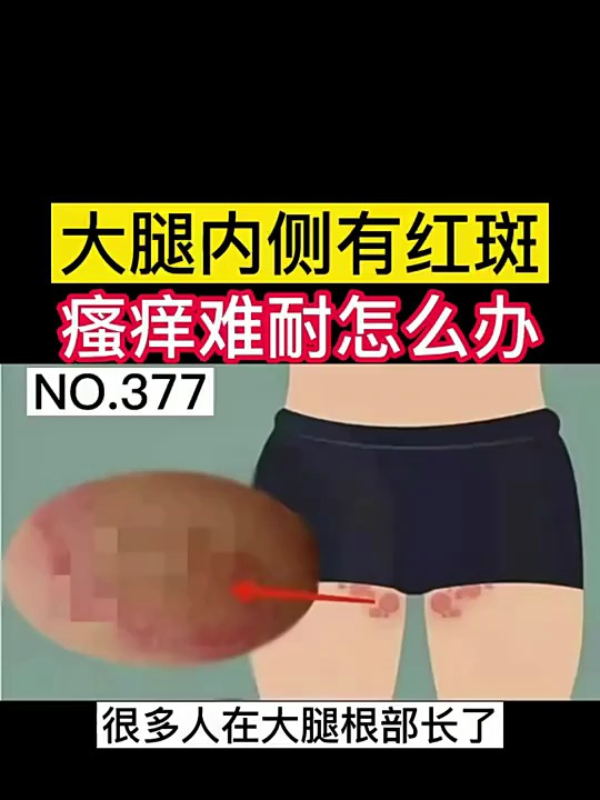 大腿内侧有红斑瘙痒难忍怎么办听听医生怎么说