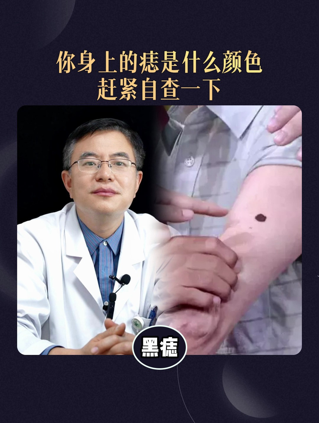 你身上的痣是什么颜色,赶紧自查一下