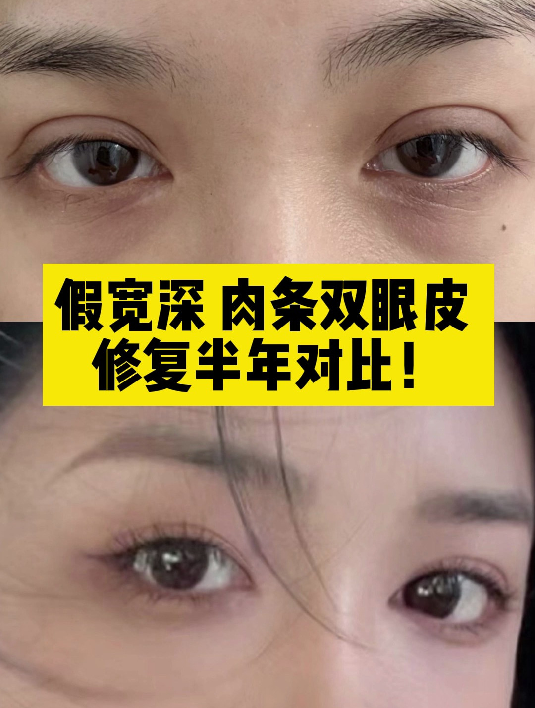 假宽深、肉条双眼皮,修复半年对比,人工痕迹变妈生感!
