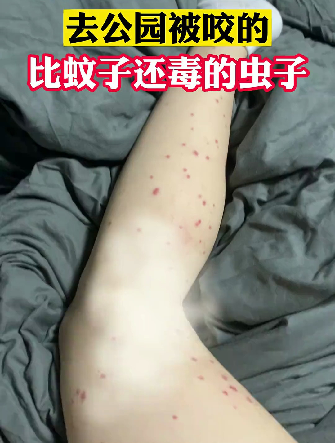 不知不觉被咬一腿包,这种虫子比蚊子还毒