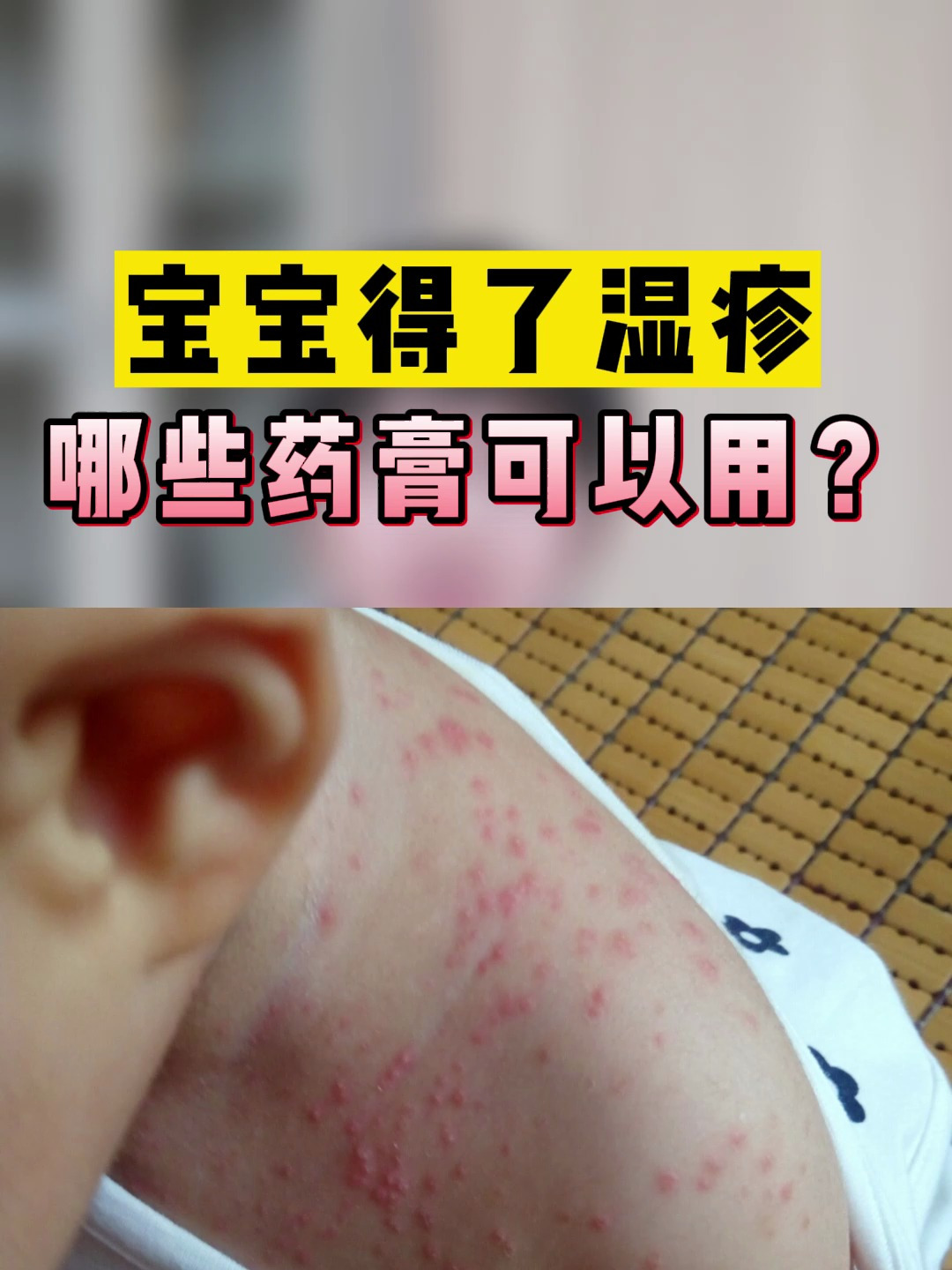 宝宝得了湿疹 哪些药膏可以用?