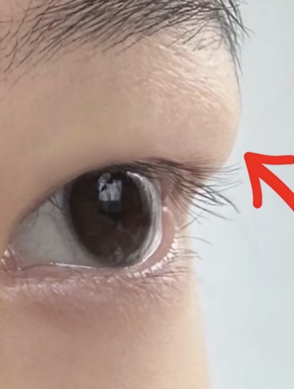 这类肿眼泡千万不能随便做双眼皮!