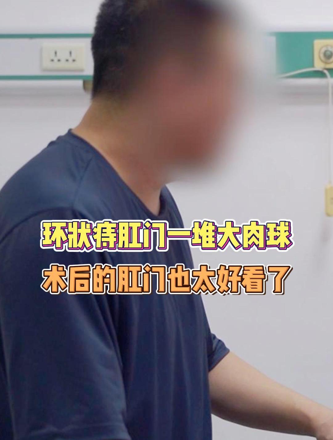 环状痔肛门一堆大肉球,术后的肛门也太好看了