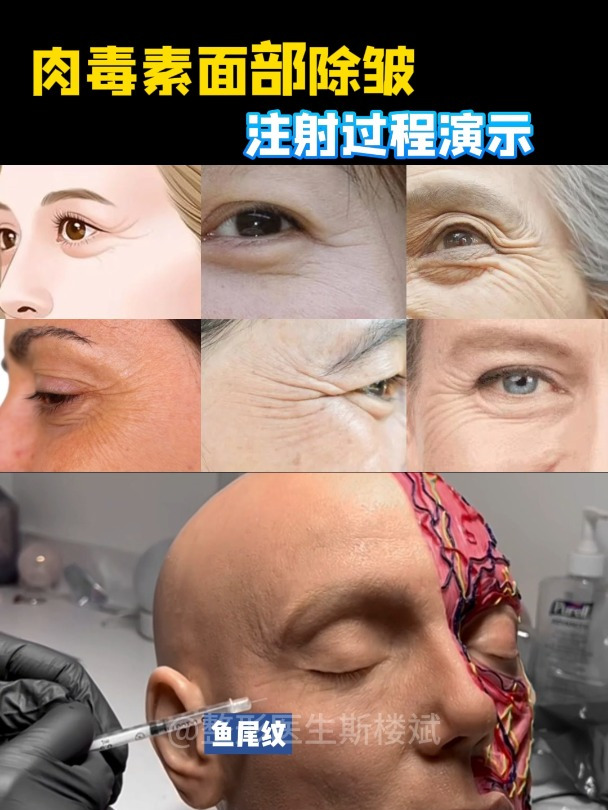 肉毒素上面部除皱注射演示