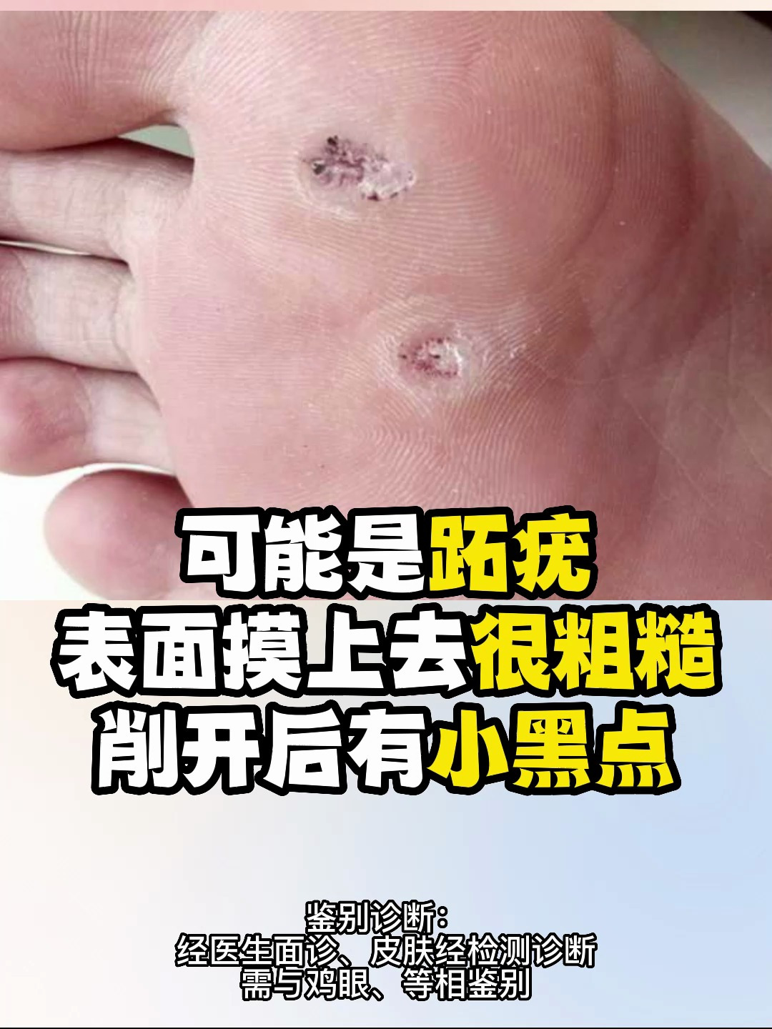 脚底的小疙瘩,走路很疼,不是鸡眼!