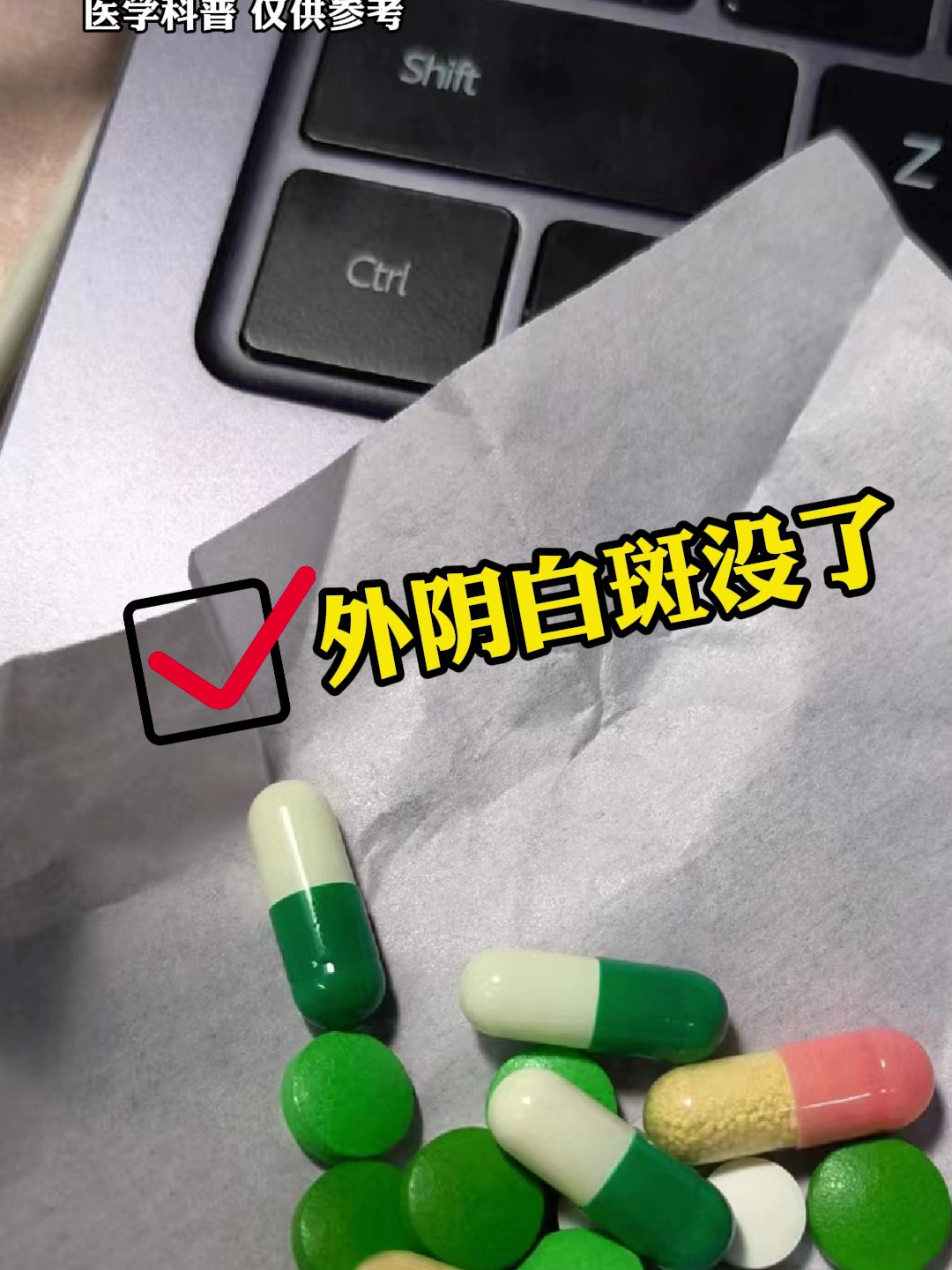外阴白斑用什么药能好?