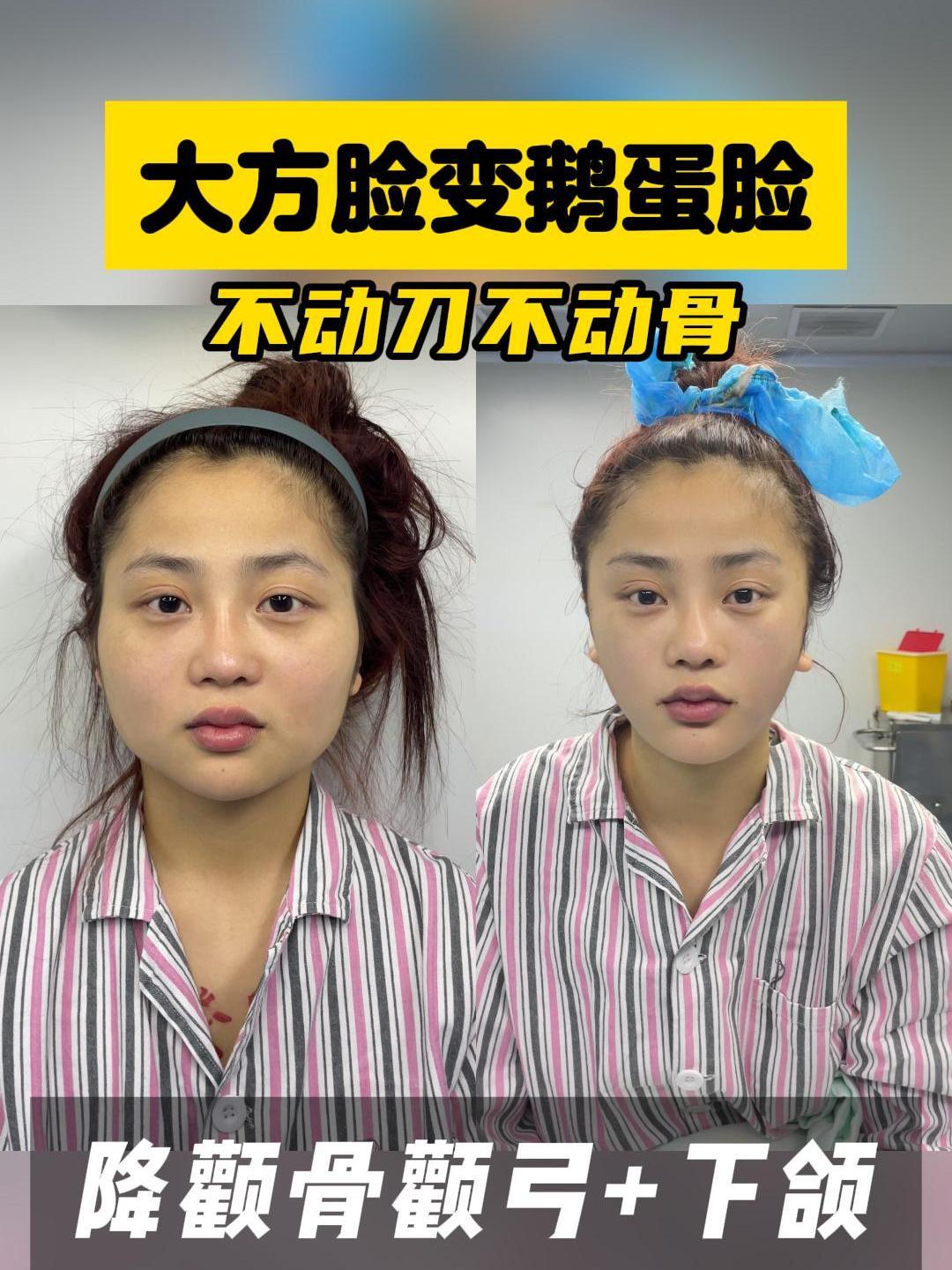 大方脸变鹅蛋脸,小姐姐:哇~这不是我吧,这变化也太大了!