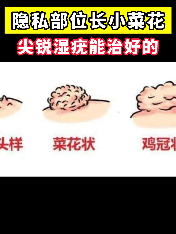 隐私部位长小菜花，尖锐湿疣能治好的