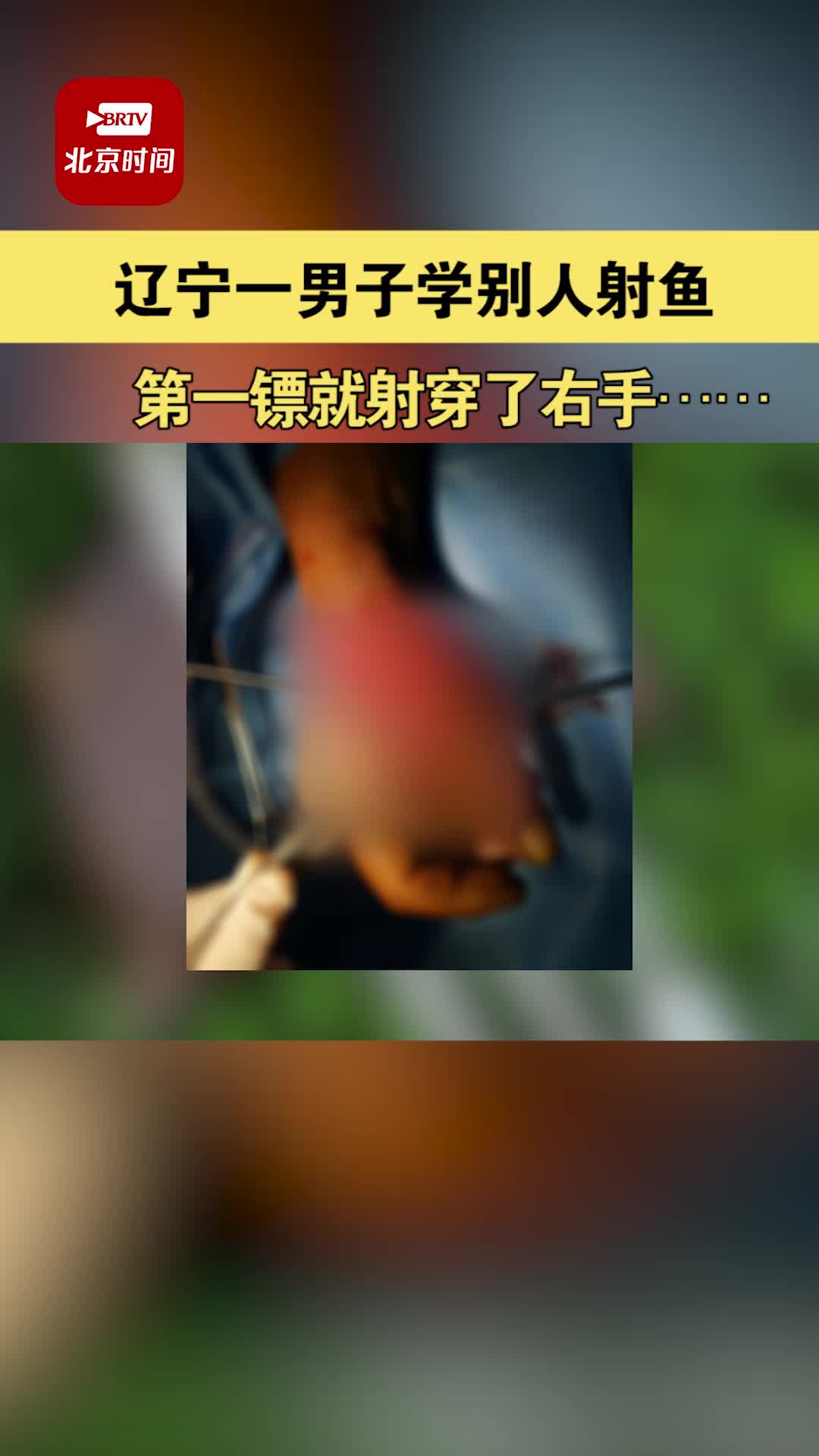 5月25日辽宁沈阳 53岁男子用鱼镖射鱼 第一镖就射穿了自己的右手,导致骨折!当事人称以后