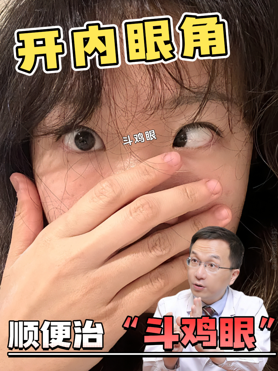 开了内眼角,顺便治了“斗鸡眼”