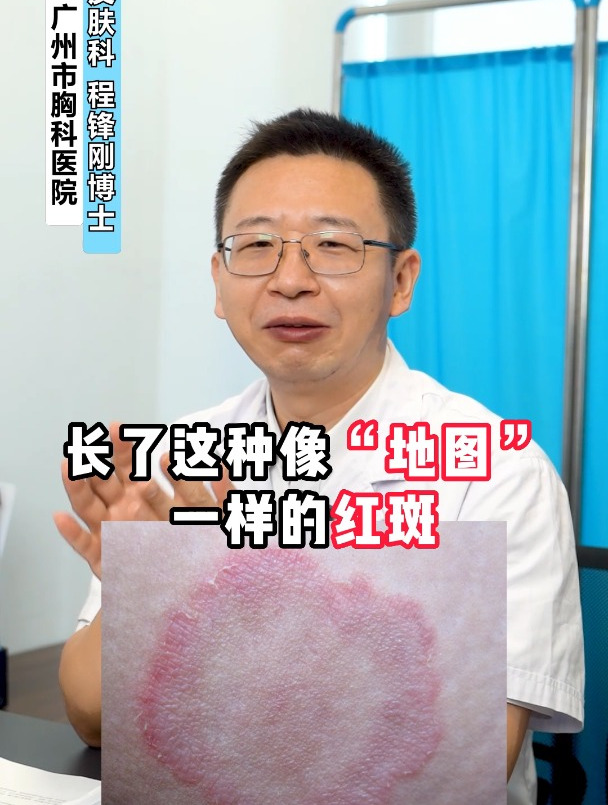 大腿根部长地图状红斑,这样处理简单有效