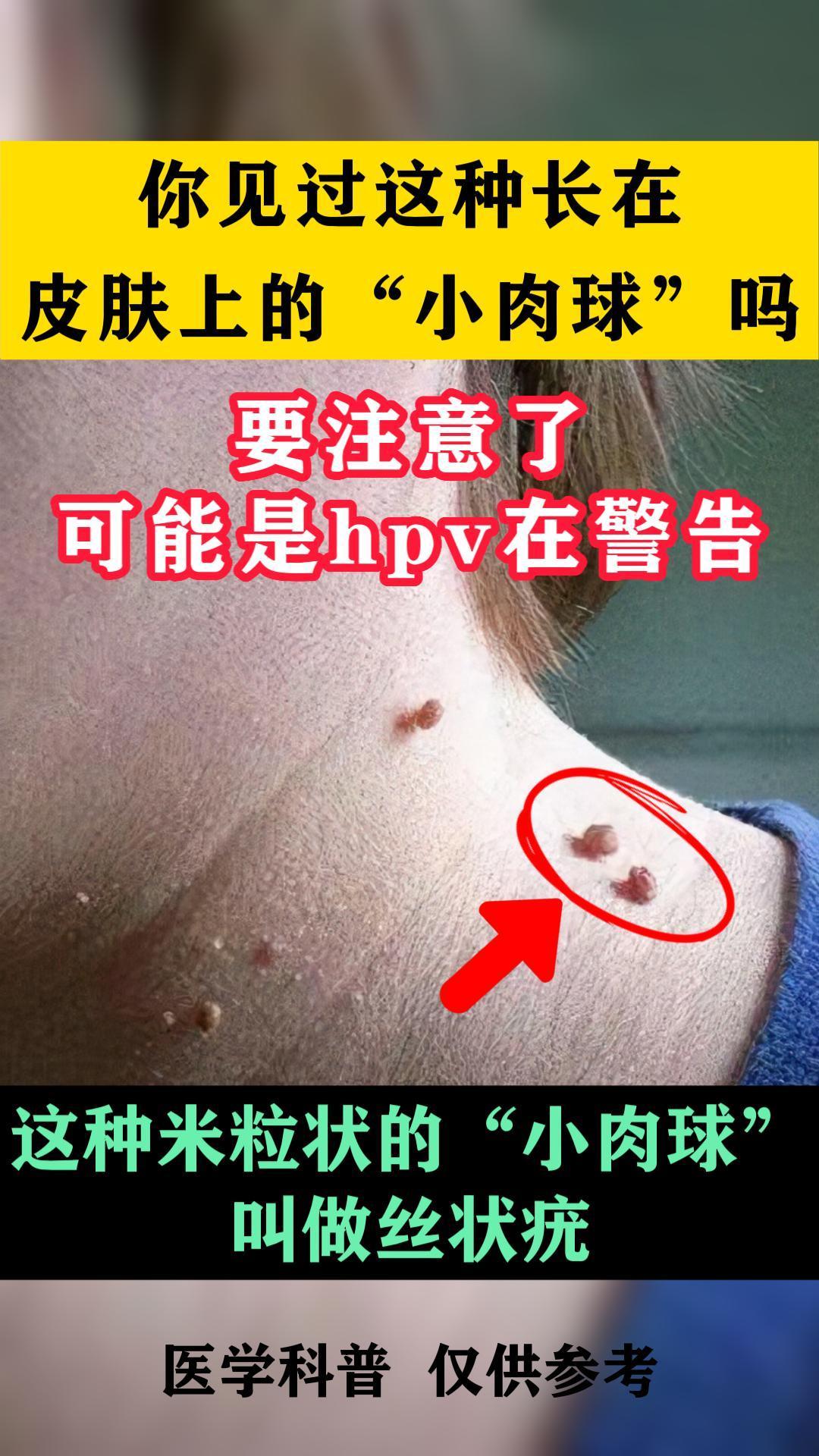 要注意了,身上长了这种东西,可能是hpv在警告
