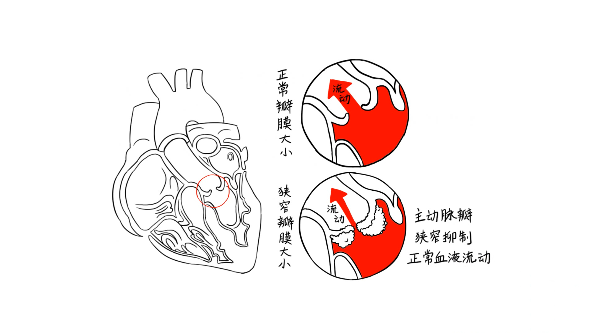 什么是心脏病?它有哪些类型?手绘动画带你轻松了解