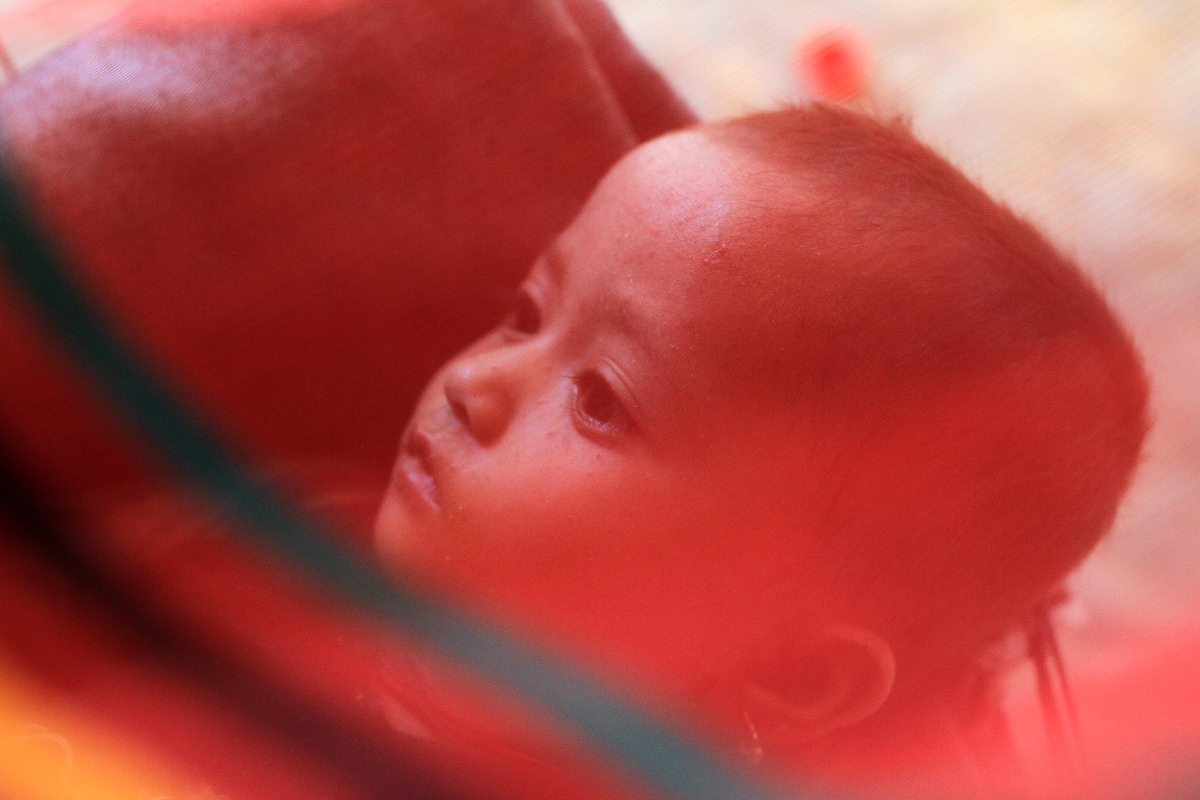 双胎减胎术：应对胎儿染色体异常的必要性