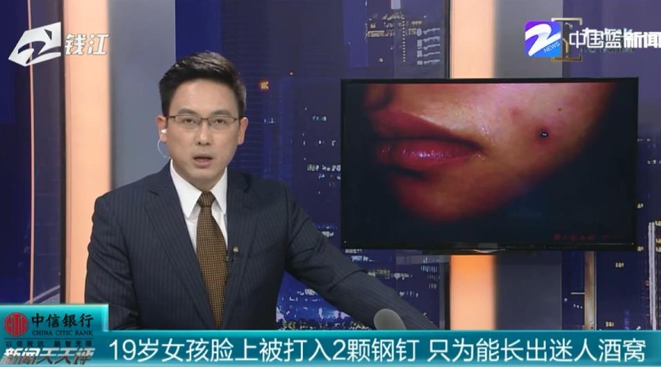 19岁女孩脸上被打入2颗钢钉 只为能长出迷人酒窝