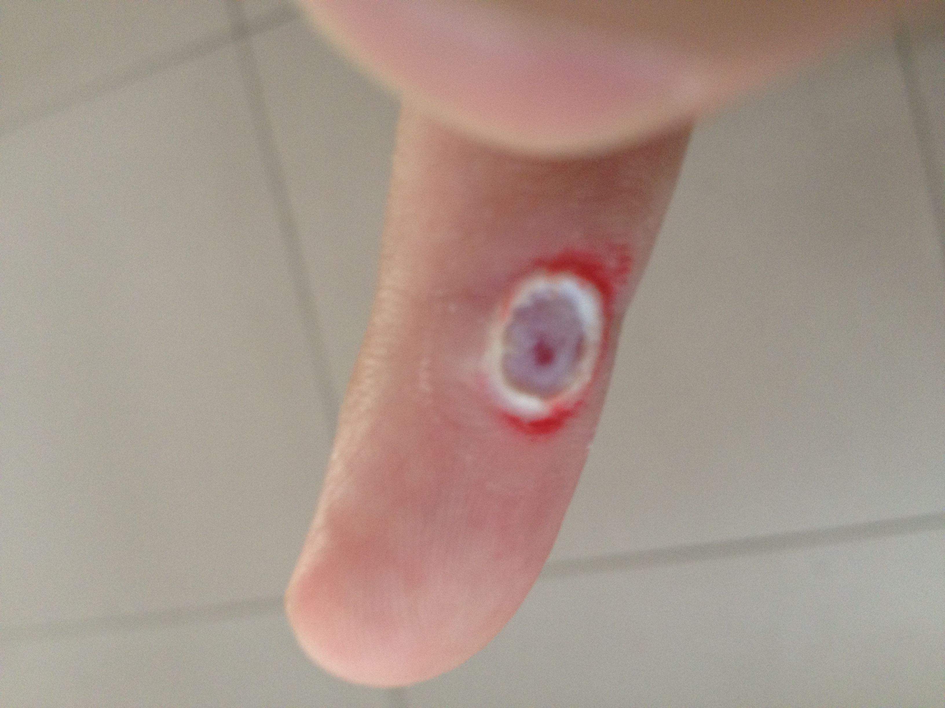 鸡眼不是什么大病,但随便挖,对自己的脚趾不利,要注意了