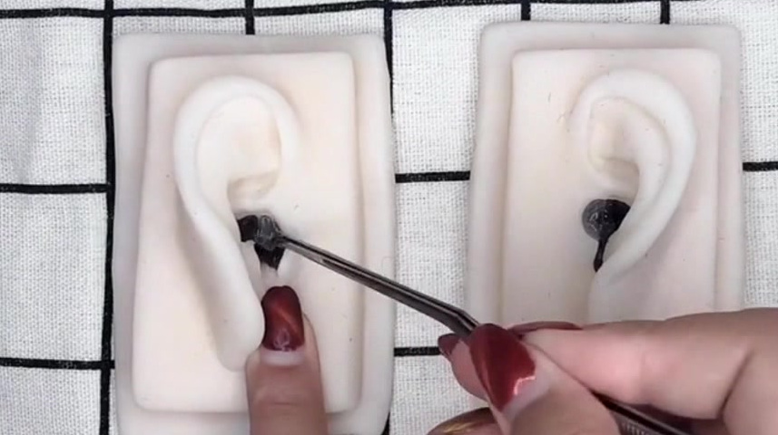 挖耳屎耵聍视频