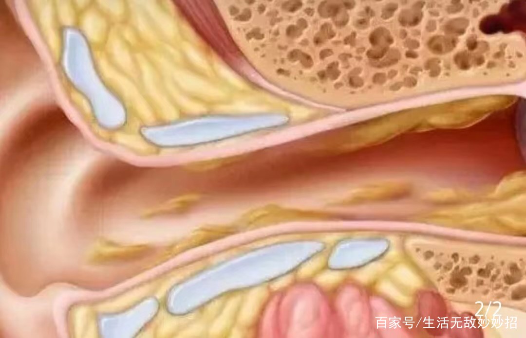 耳屎究竟要不要掏出来?原来这么多年都做错