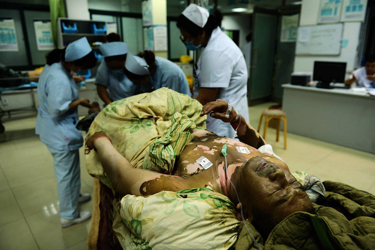 特重度烧伤的心理护理：帮助患者重拾信心和健康