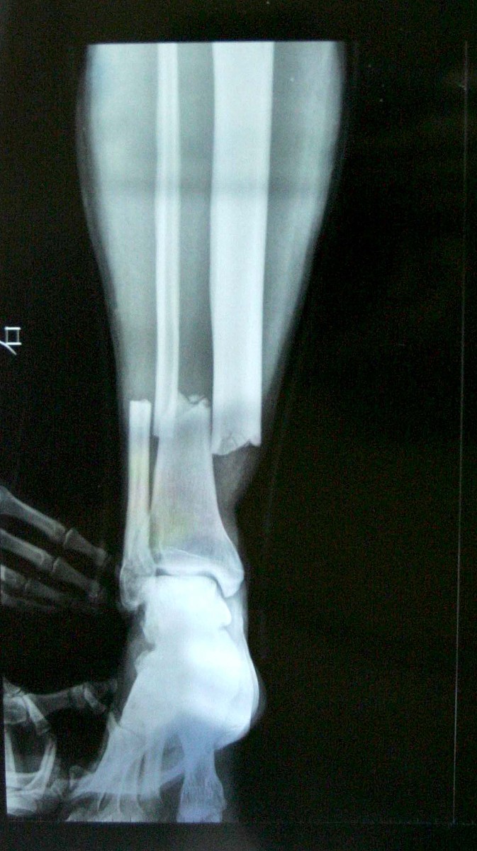 右胫骨平台粉碎性骨折：病因、症状、治疗及康复